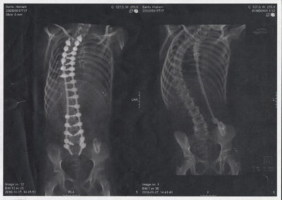 Röntgenbilder på Hisham Bahlos ryggrad